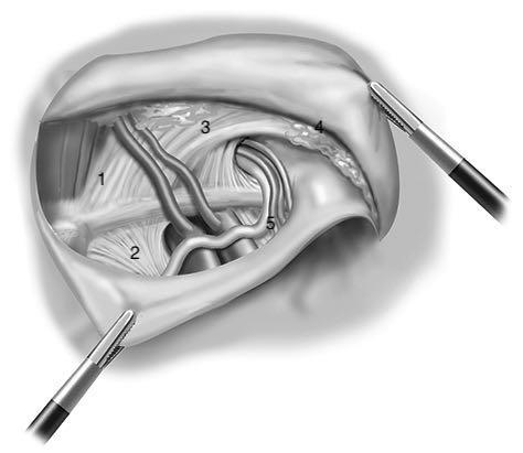 O reparo da TAPP (Transabdominal Pré Peritoneal) envolve ... - Gran ...